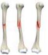 Ознаки закритого перелому кісток кінцівок